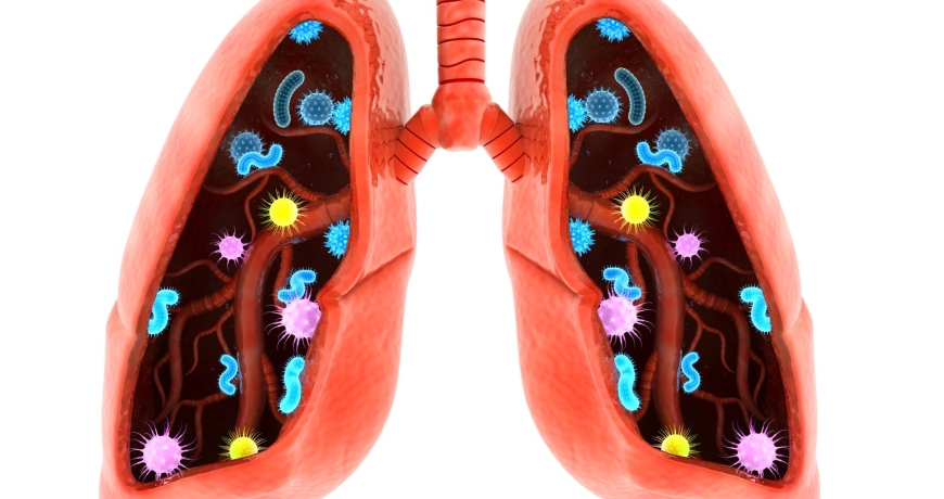 Choroby śródmiąższowe płuc na wizualizacji płuc człowieka z bakteriami i wirusami.