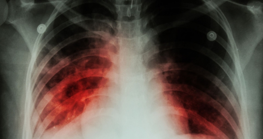 Gruźlica płuc zaznaczona kolorem czerwonym na prześwietleniu płuc pacjenta.