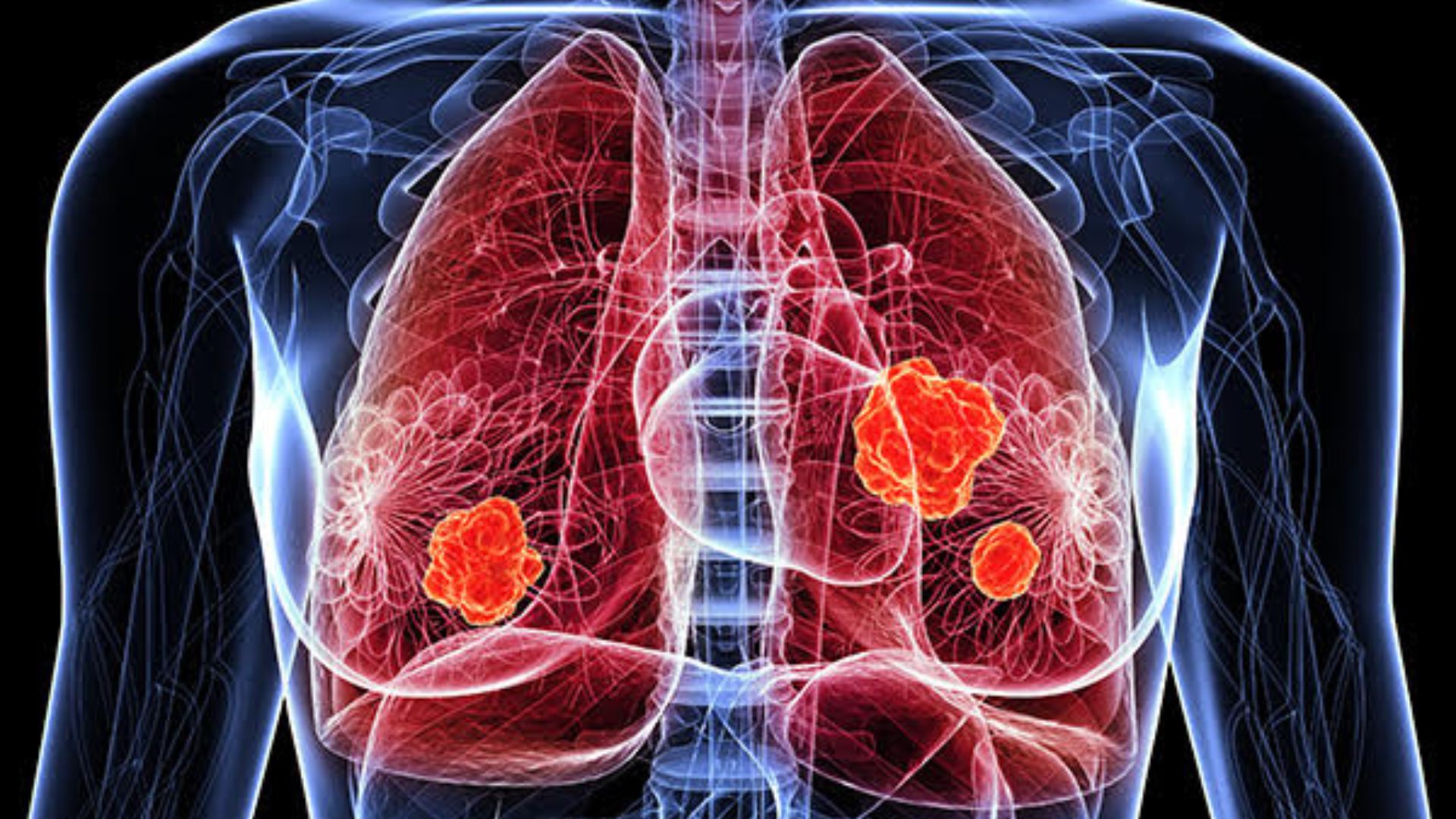Co oznaczają guzy na płucach?