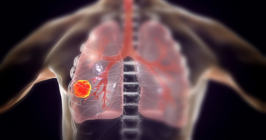 Rak płuc na graficznej wizualizacji z widocznym guzem w na jednym z płatów.