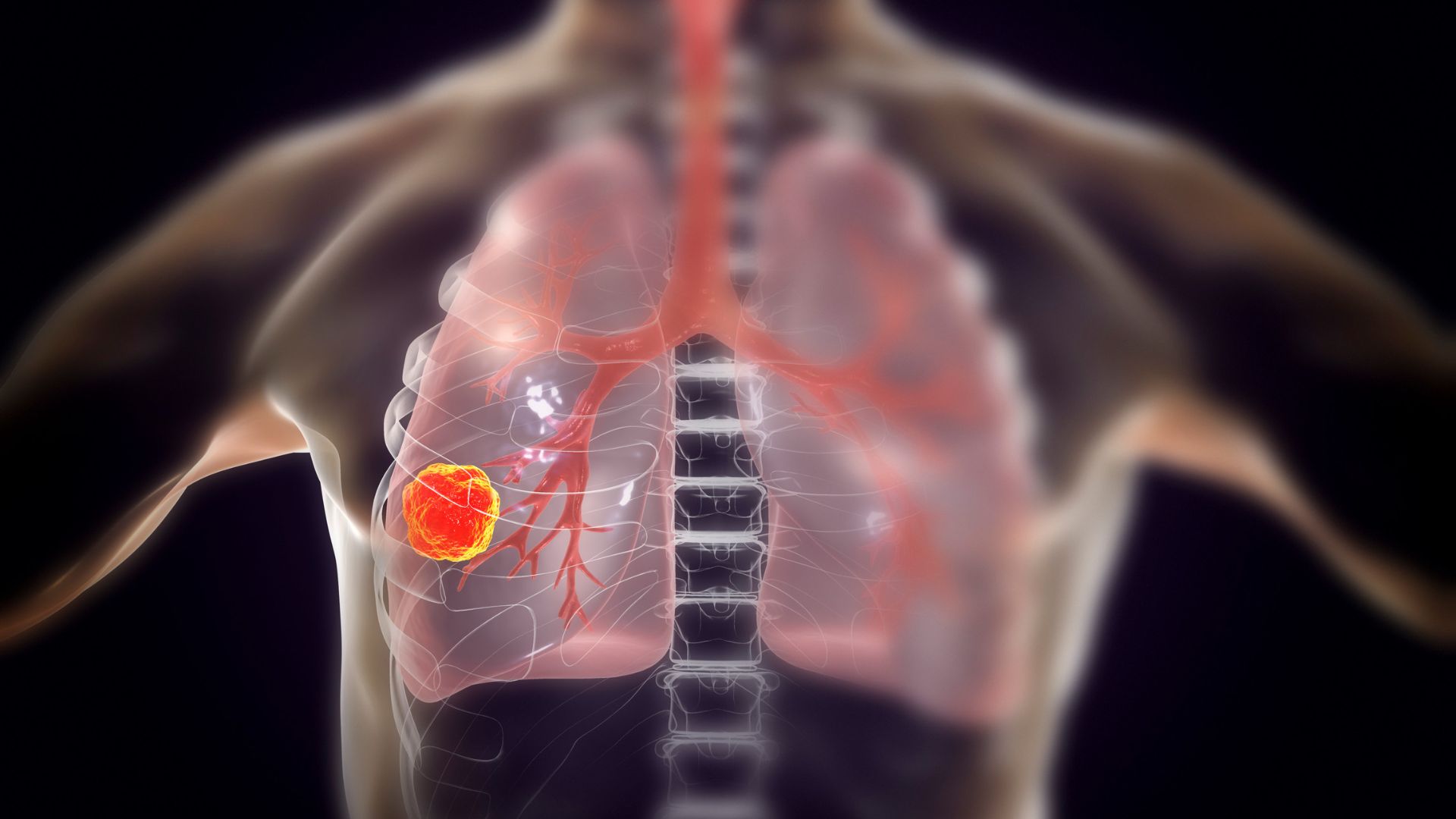Rak płuc – objawy, leczenie i rokowania